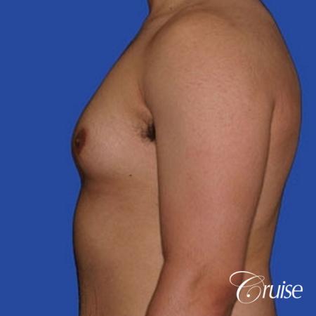 minor gyne young adult with best scars - Before Image 2