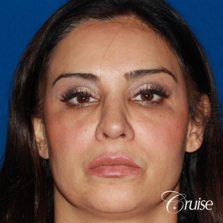 Fat Transfer - Face: Patient 17 - After Image
