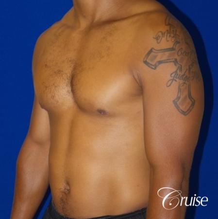 gynecomastia caused by testosterone - After 3