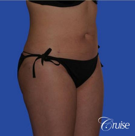 best pictures of liposuction with plastic surgeon in Newport Beach - After Image 4