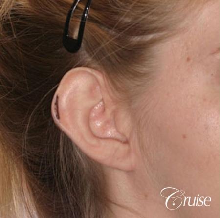 best otoplasty photos by top plastic surgeon - Before Image 2