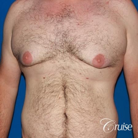 Severe Gynecomastia -Free Nipple Graft - Before Image 1