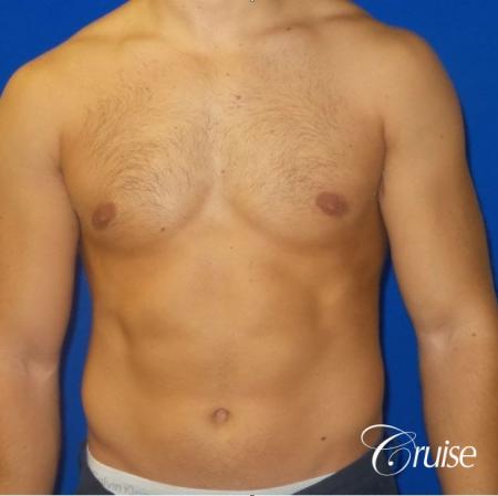 male breast reduction surgery newport beach - After Image 1