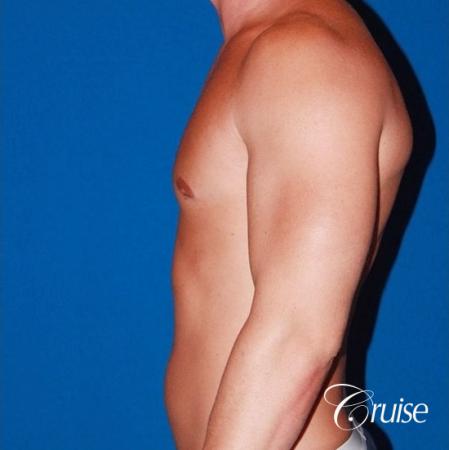 32 yo with Gynecomatia and Puffy Nipple - After Image 2