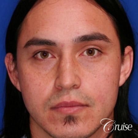 best male otoplasty orange county plastic surgeon - Before Image 1