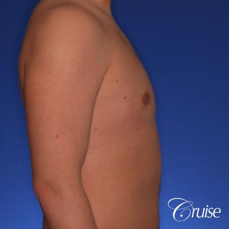 best puffy nipple gynecomastia results with plastic surgeon, Joseph Cruise, M.D. - After Image 3