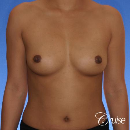 Breast Augmentation - Before Image 1