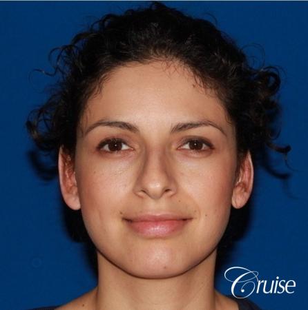 best otoplasty with natural appearance on female - After Image 1