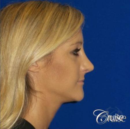 Best Rhinoplasty results Newport Beach CA - After Image 2