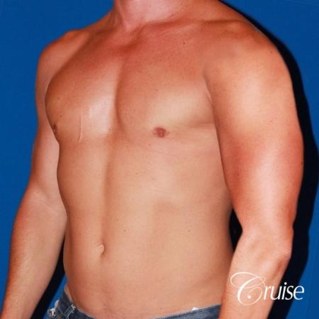 body builder with Gynecomastia puffy nipple - After Image 3
