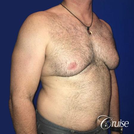 Severe Gynecomastia Correction - Before 2