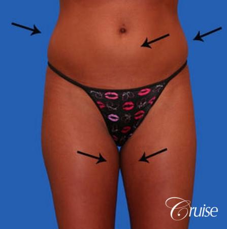 best liposuction abdomen and love handles - Before Image 1