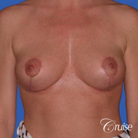 best breast reduction without implants - After Image 1