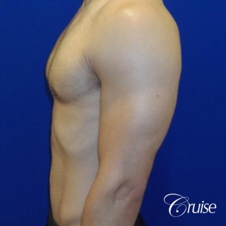 gynecomastia correction newport beach - After 2