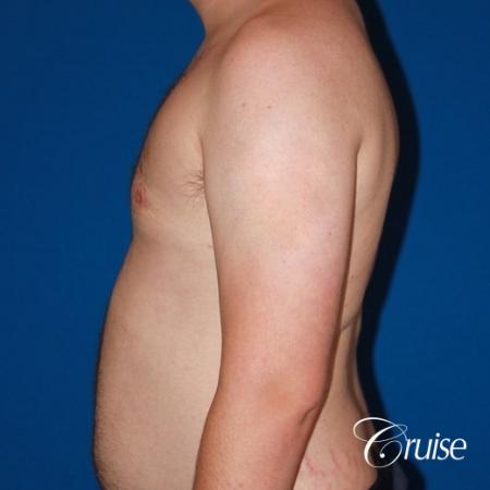 asymmetric gynecomastia moderate - After Image 3