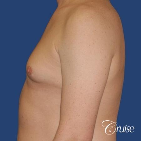 moderate gynecomastia on adult donut lift - Before Image 2