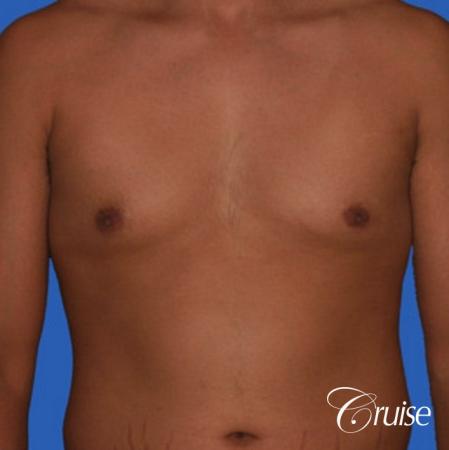 26yr old with mild gynecomastia - Before Image 1