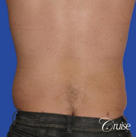 male liposuction abdomen flanks with Gynecomastia - After Image 2