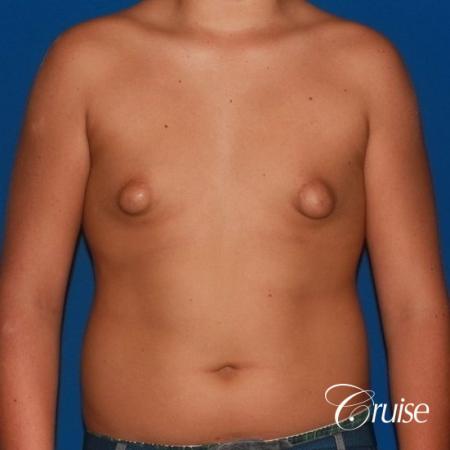 severe puffy nipple on teenager - Before Image 1