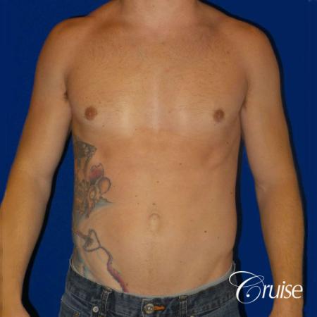body builder puffy nipple gynecomastia - After 1