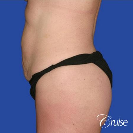 best pictures of liposuction abdomen with skin laxity - After Image 2