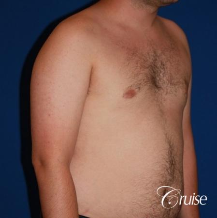 asymmetric gynecomastia moderate - After Image 4