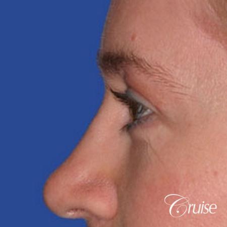 best specialist for upper eyelid surgery - After Image 2