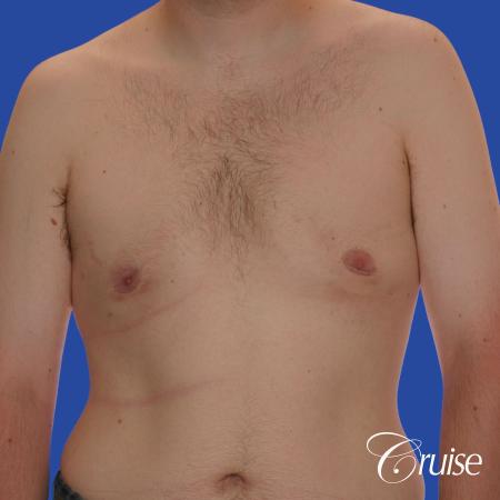 moderate gyne on 31 yr old male - After Image 1