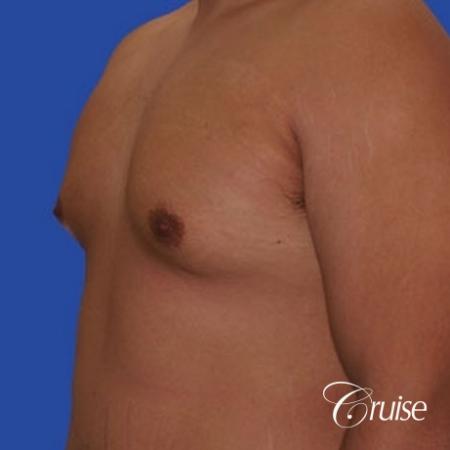 mild gyne on 24yr old adult - Before Image 3