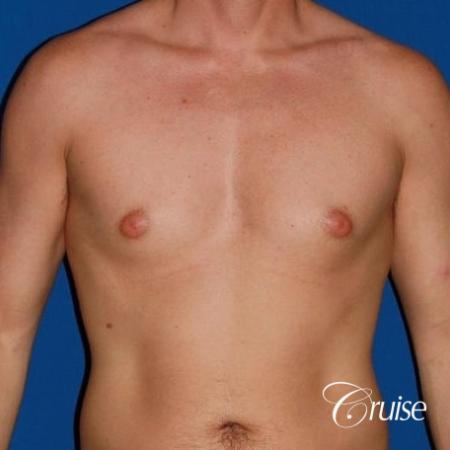 puffy nipple on low body fat - Before Image 1