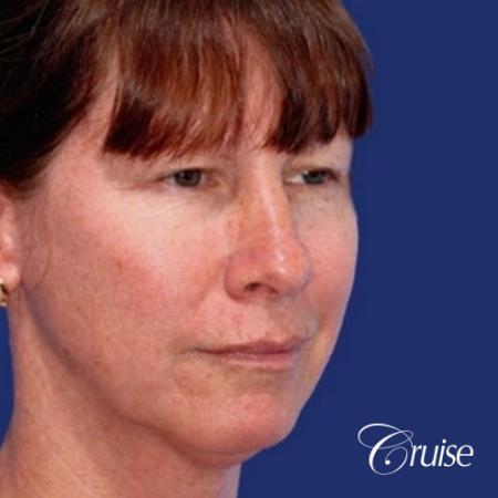 52 year old with chin augmentation and facelift - Before Image 2