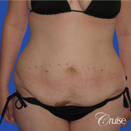 best liposuction tummy tuck - Before Image 1