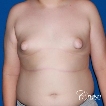 young boy with gynecomastia during puberty gets surgery - Before Image 1