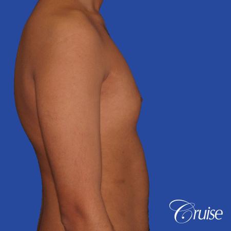 best before and after results for gynecomastia surgery - Before and After 3