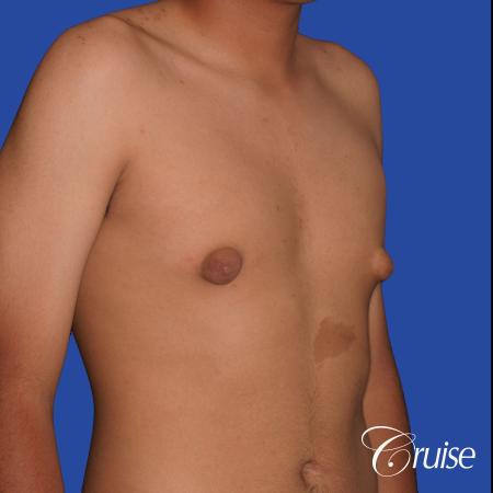 gynecomastia patient gets nipple reduction for best results - Before and After Image 5