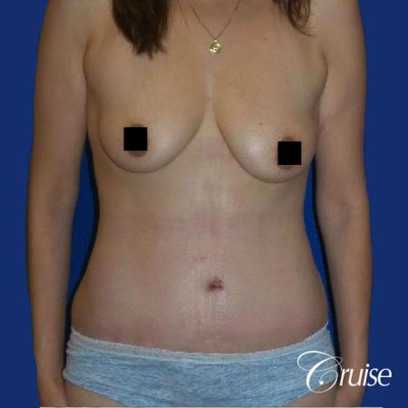 Best tummy tuck incisions orange county - After Image 1