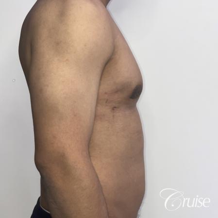 gynecomastia surgery - After 4
