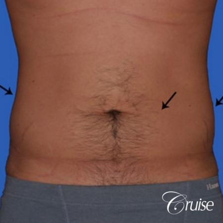 best liposuction to contour a males body - Before Image 1