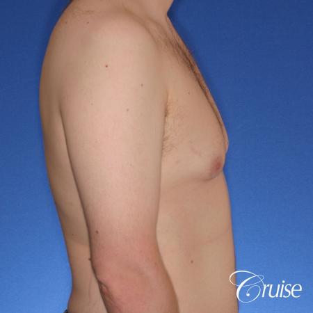 moderate gyne on 31 yr old male - Before Image 3