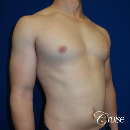 Adult gynecomastia before and after photos - Before Image 2