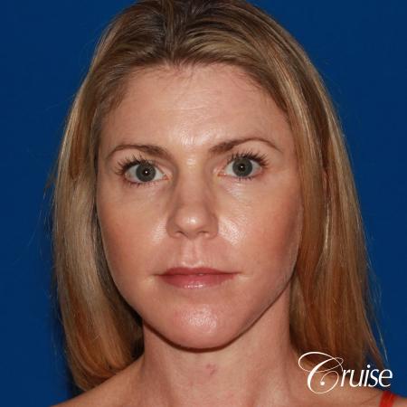 best small anatomic implant photos - After Image 1