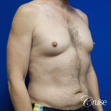 Best Gynecomastia surgeons Los Angeles - Before Image 2
