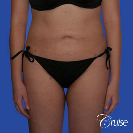 best pictures of liposuction with plastic surgeon in Newport Beach - After Image 3