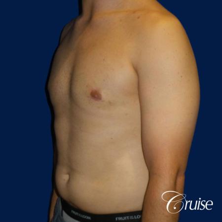 gyne before and after photos orange county ca - After Image 2