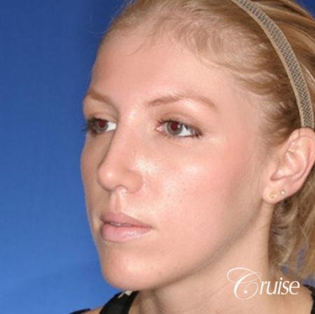 young female with large anatomic chin implant - After Image 3