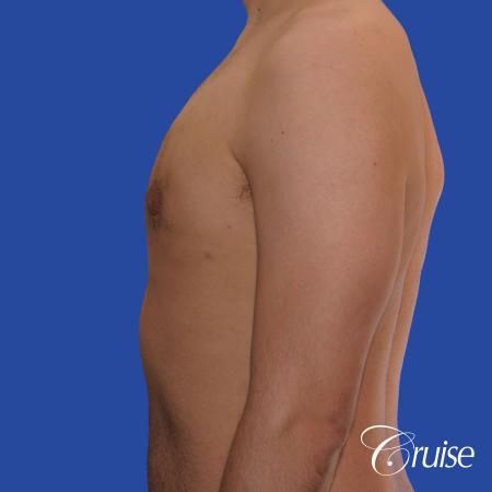20 year old with moderate gynecomastia - After Image 2
