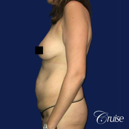 Best tummy tuck incisions orange county - Before Image 3