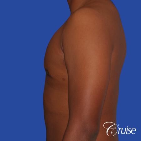 24 yr. old gets gynecomastia surgery with best scars - After Image 2