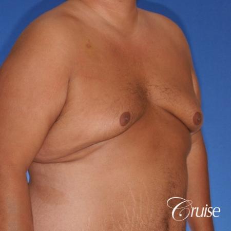 free nipple graft gynecomastia results - Before Image 2