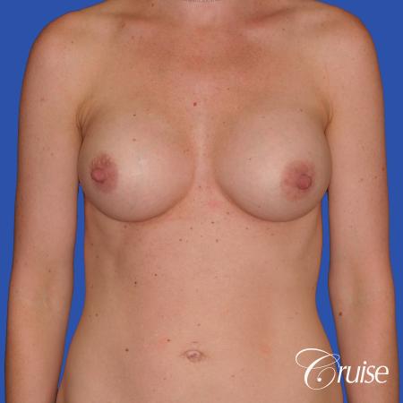 Breast Augmentation - After Image 1